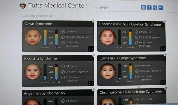 Приложение Face2Gene диагностирует редкие генетические аномалии по обычной фотографии